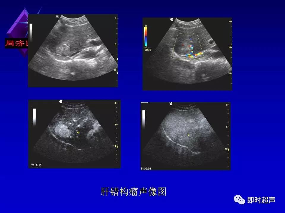 正常肝脏的超声解剖及局限病变的超声诊断