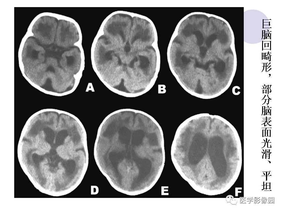 常见先天性颅脑发育畸形的影像诊断丨影像天地