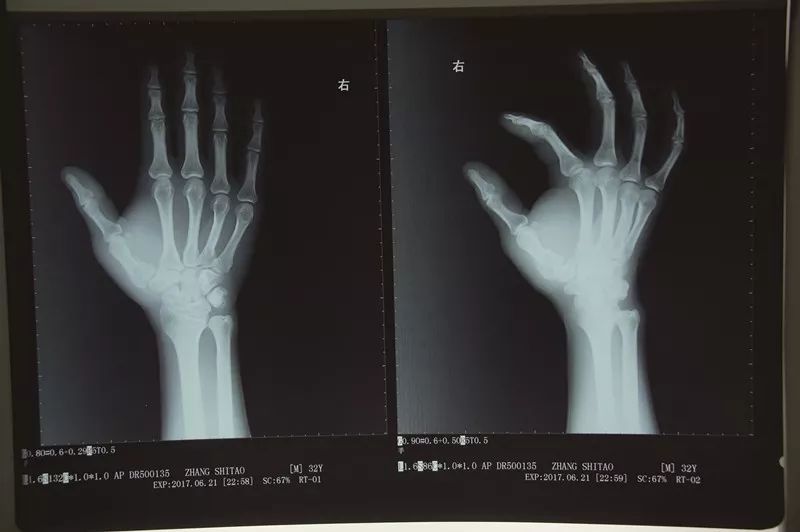 会诊中,王法医与临床医学专家对被害人右手的x光片进行仔细观察和分析