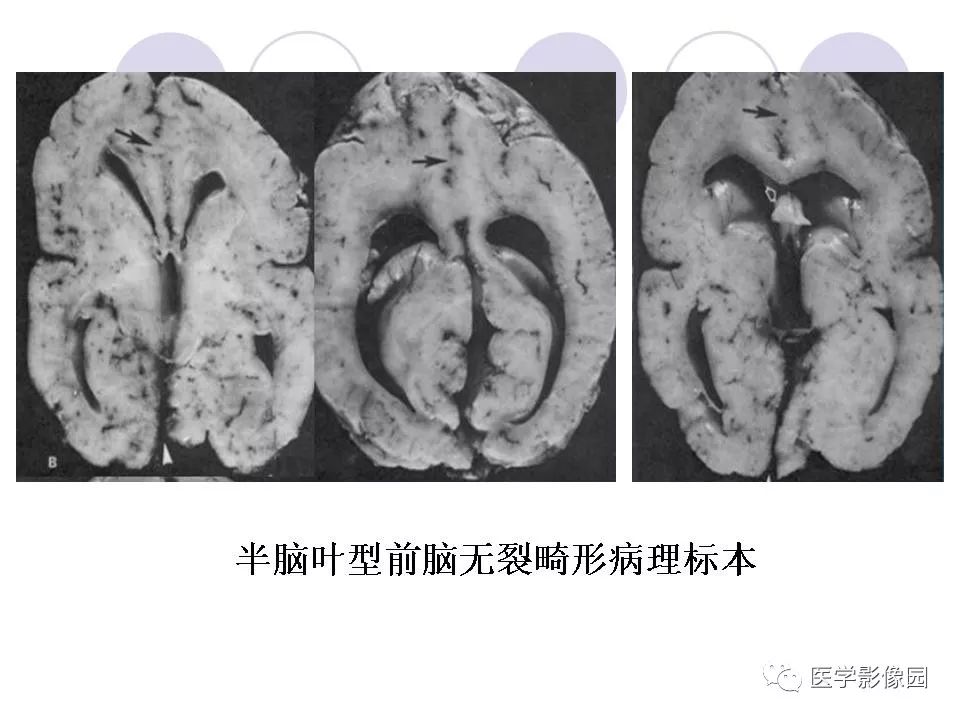 常见先天性颅脑发育畸形的影像诊断丨影像天地