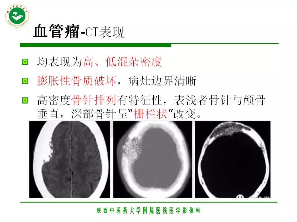 颅骨良性肿瘤的影像学表现