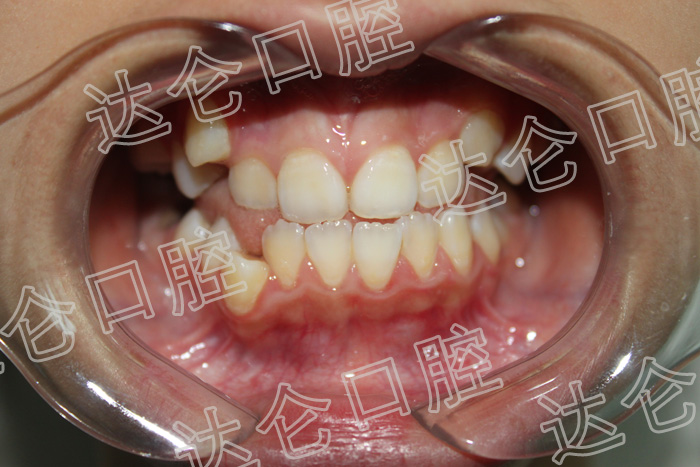 牙齿问题:牙齿排列非常不整齐,家长带其前来 患者需求:不想要成为"