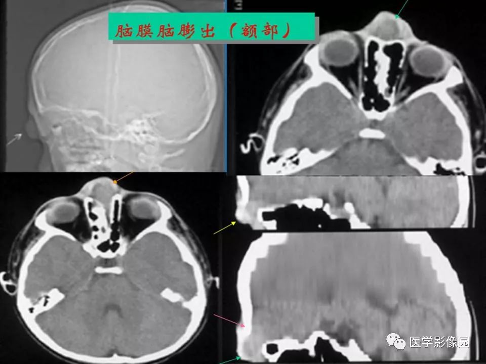 常见先天性颅脑发育畸形的影像诊断丨影像天地