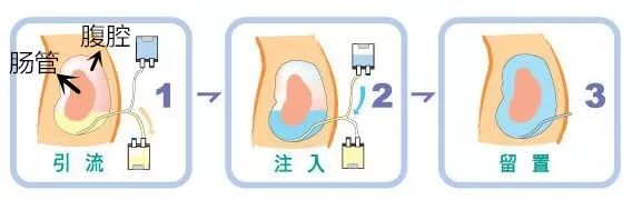 简易腹膜透析示意图