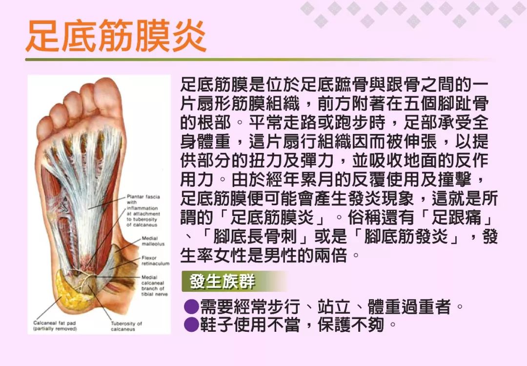 详细分析脚底筋膜炎plantarfasciitis