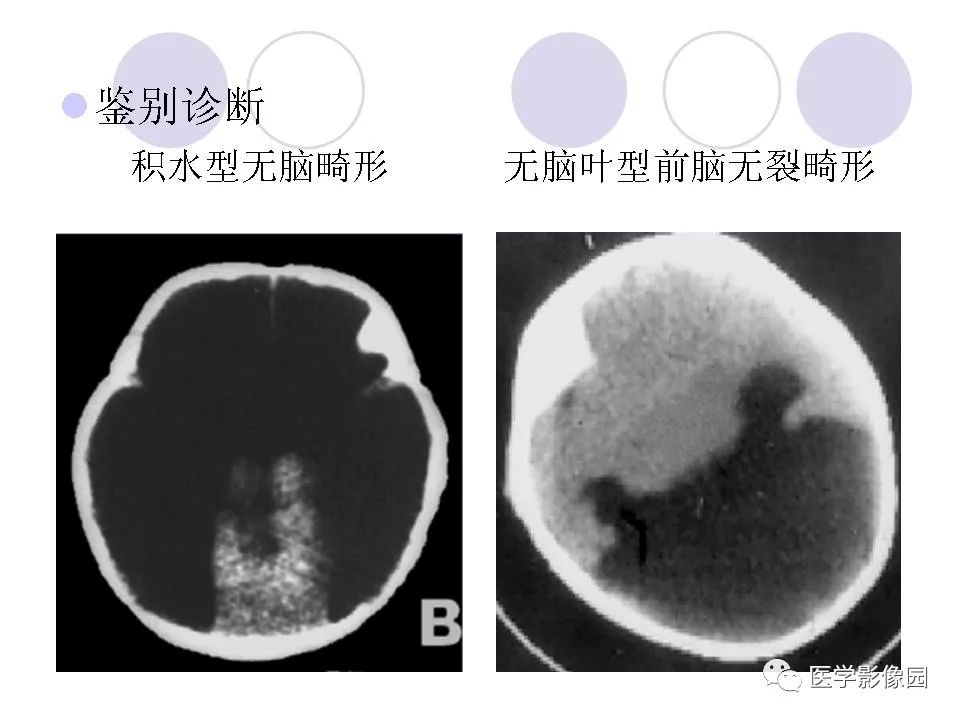 常见先天性颅脑发育畸形的影像诊断丨影像天地