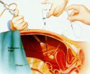 腹腔镜卵巢打孔术:腹腔镜卵巢打孔术(laparoscopic ovarian drilling