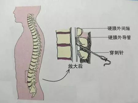 椎管就是脊椎中间的 "孔",在医学解剖上叫椎孔