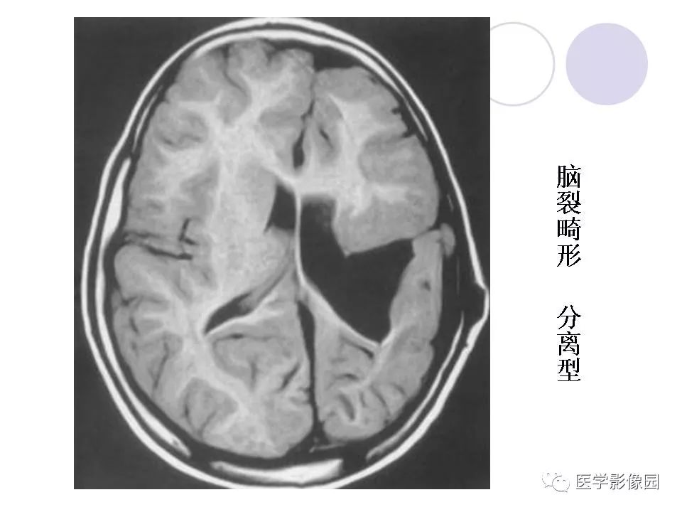 常见先天性颅脑发育畸形的影像诊断丨影像天地