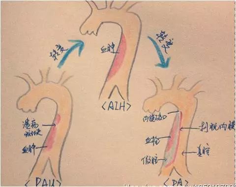 健康附一丨一颗比主动脉夹层更加凶险的"炸弹"@主动脉壁间血肿
