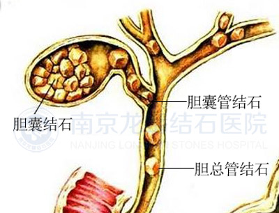 胆总管结石