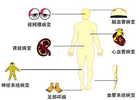 不一样,得了糖尿病,如果不及时治疗的话,糖尿病并发症就会接踵而至,不