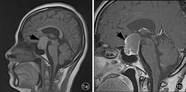 [病理研究]罕见的鞍区和鞍上脑室外神经细胞瘤如何与垂体腺瘤等区分