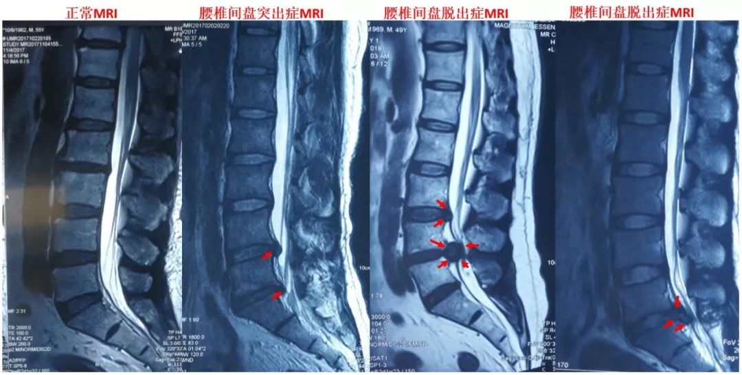 拒走"冤枉路",专家教你搞定腰椎间盘突出!