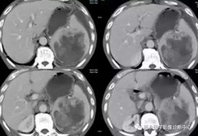 医生必须掌握的21种腹部疼痛原因