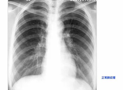 "肺"腑之言】两肺纹理增粗是怎么回事?