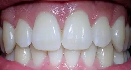 正常的牙龈是粉红色有光泽的,质地坚韧.