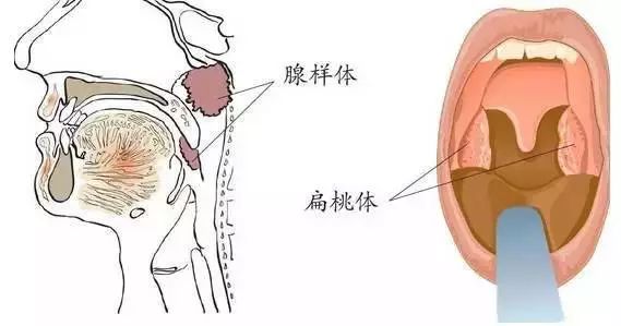 腺样体增生肥大,让孩子变丑又变笨