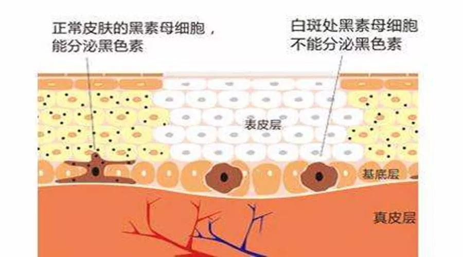 黑色素母细胞帮助白白们和白癜风说拜拜!