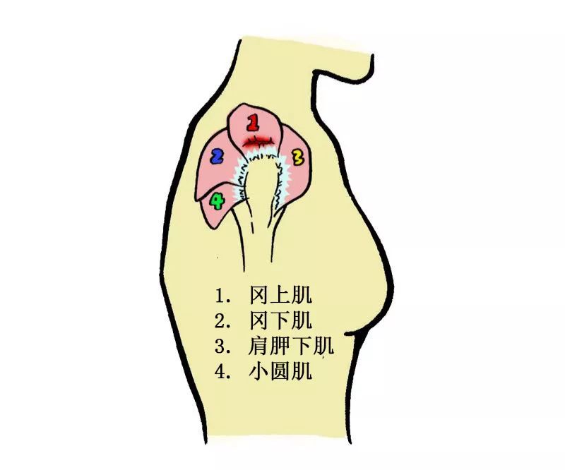 肩袖是肩关节非常重要的组成部分,它分别由上方的 冈上肌腱,后下方的