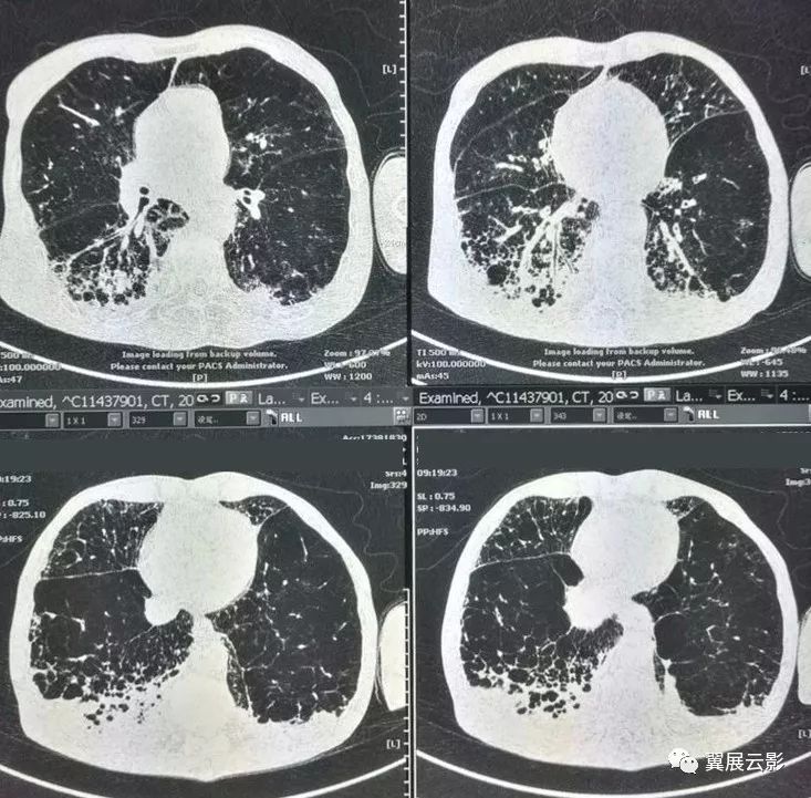 蜂窝肺的定义与探讨