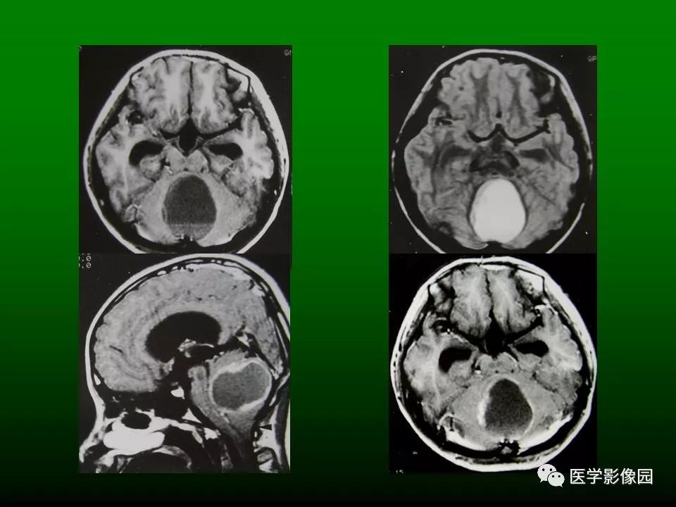 脑肿瘤的病理和影像学特征一丨影像天地