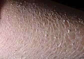 冬季气候干燥,皮肤表面的水分也容易蒸发,造成皮肤干燥起屑,尤其是