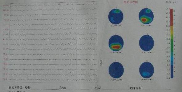 脑电图:轻度异常