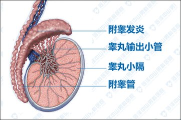 3,附睾炎患者会出现睾丸疼痛,并有阴囊,大腿根部以及腹股沟区域放射