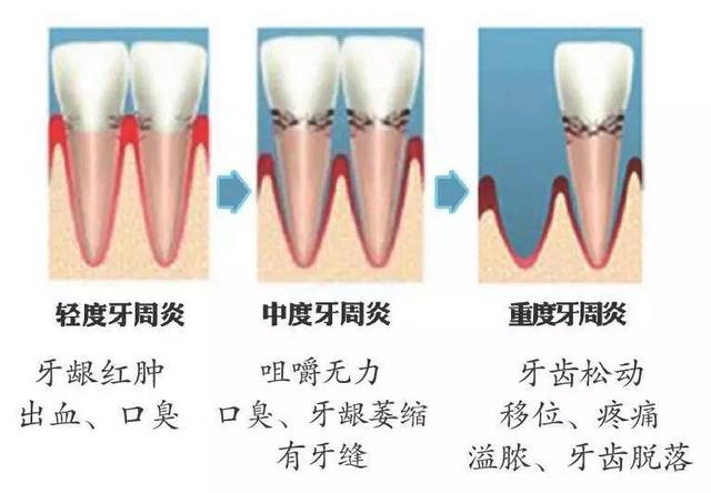 答 你这么年轻,就患上慢性重度牙周炎.