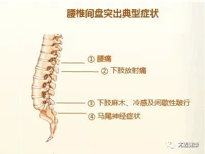 ○ 腰椎间盘突出典型症状