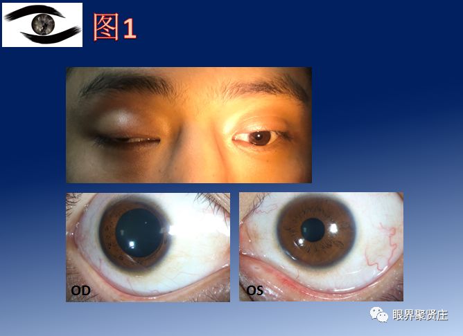 提示: 点击图片后,可放大查阅. 图1. 右侧动眼神经麻痹