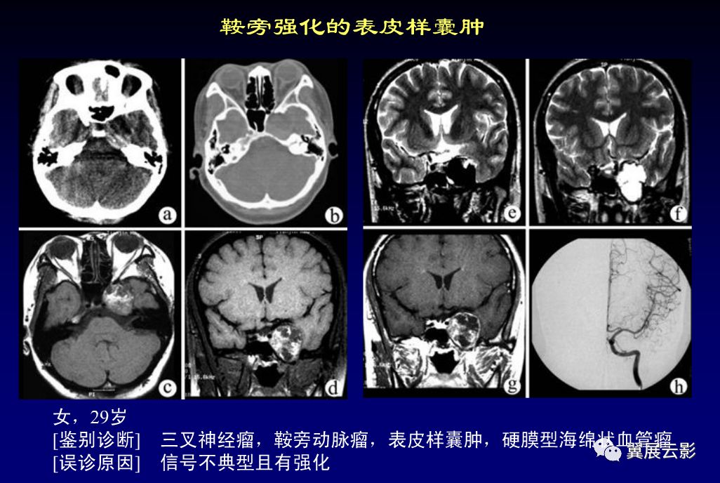 20种脑瘤疑难病例影像学诊断分析