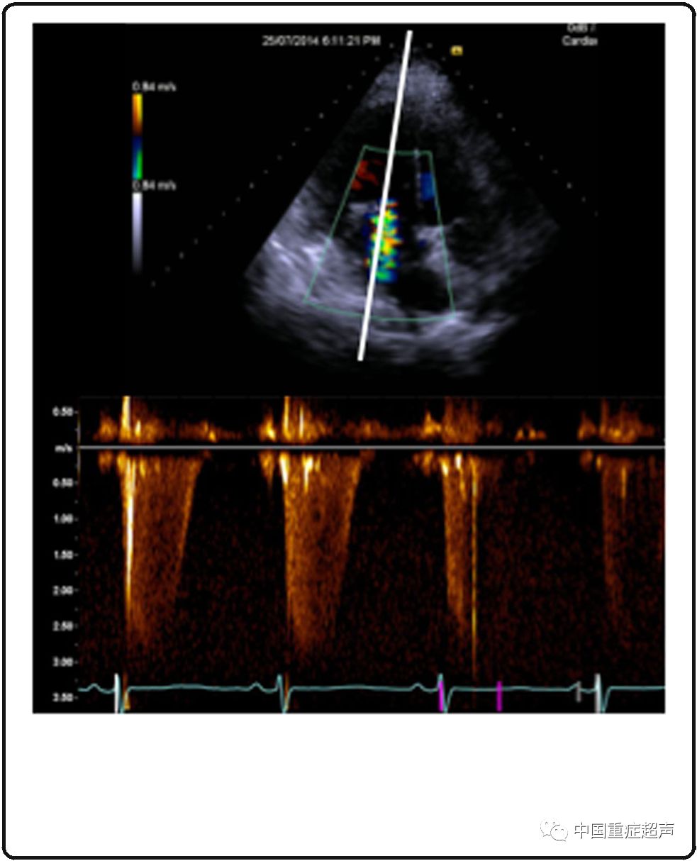 综合重症心脏超声的亮点与陷阱(3)