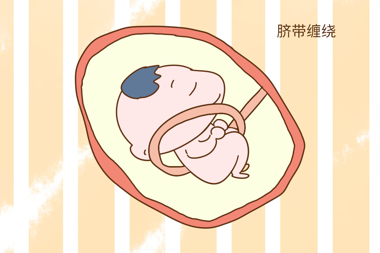 随着妊娠周期的增加,有些孕妈在产检时,会发现胎儿出现了脐带绕颈的