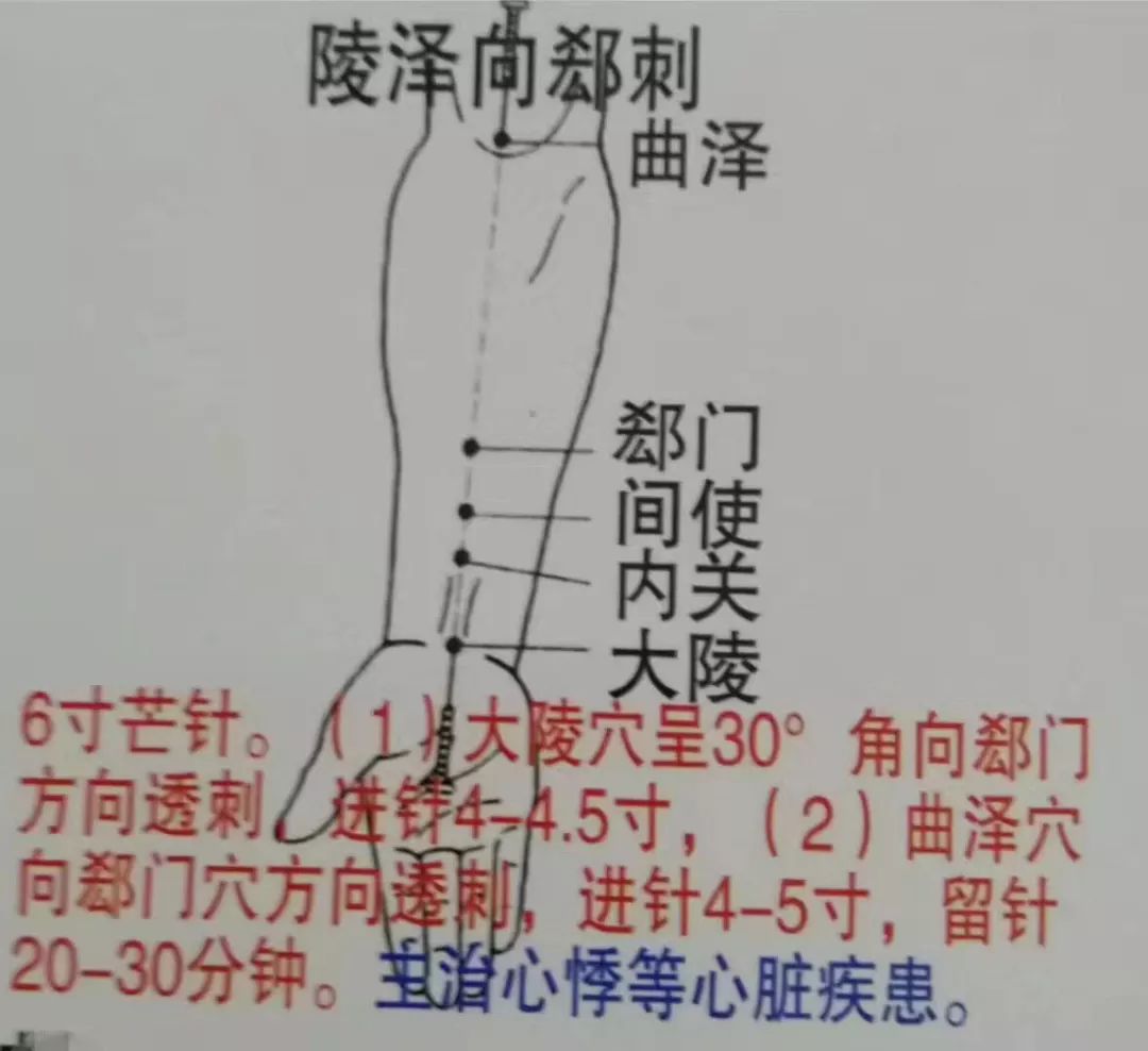 中医针灸各种刺法图文讲解