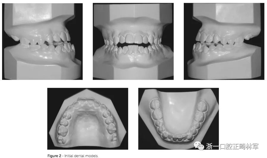 影像学检查:全景片提示牙列完整,第三磨牙正在发育,无明显畸形(图3).