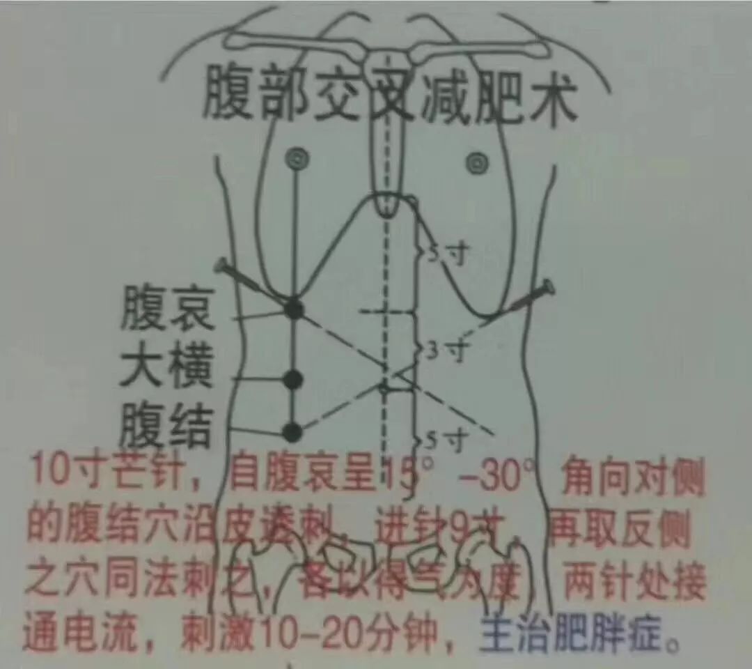 中医针灸各种刺法(图文讲解)