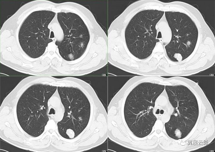 8种肺部良性肿瘤及肿瘤样病变