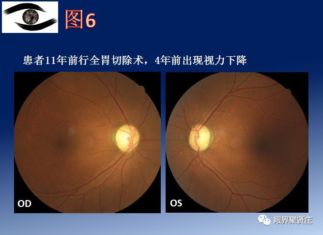 图4. 前部缺血性视神经病变(aion)