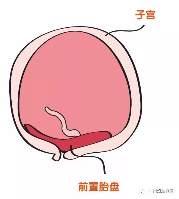 01 阴道流血 常见原因是前置胎盘和胎盘早剥,这两种出血都很危险,可