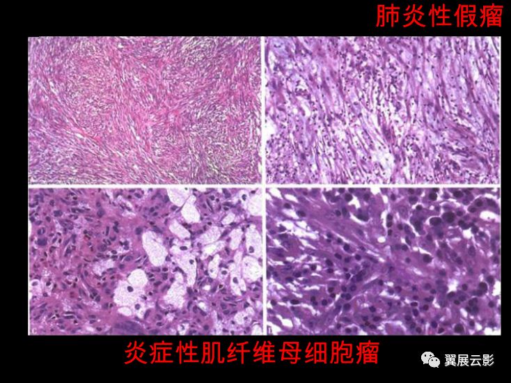 8种肺部良性肿瘤及肿瘤样病变