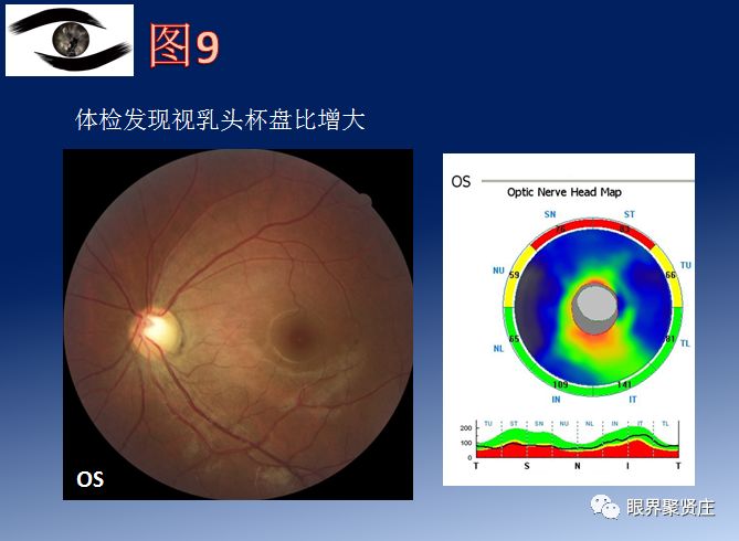 例患者具备完全性动眼神经麻痹的典型表现:右眼上睑下垂,大度数外斜视