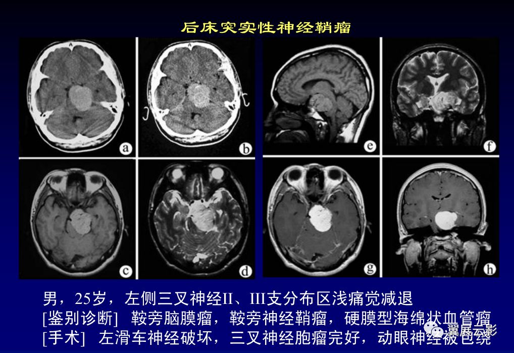 20种脑瘤疑难病例影像学诊断分析