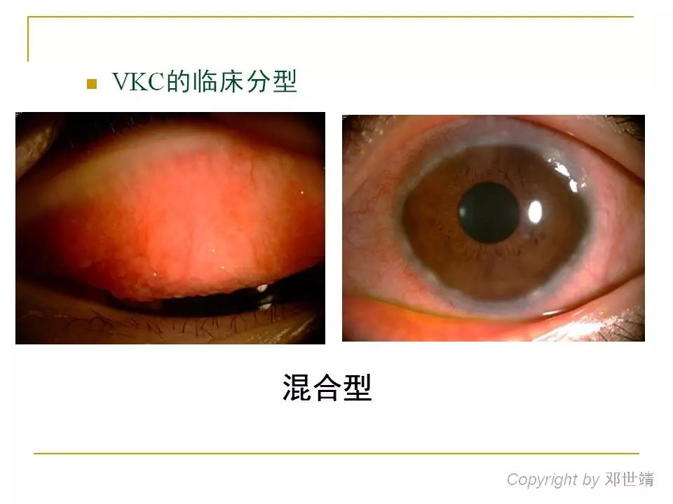 (按住图片可左右滑动)角膜病变文献报道春季卡他性结膜炎患者中,50%