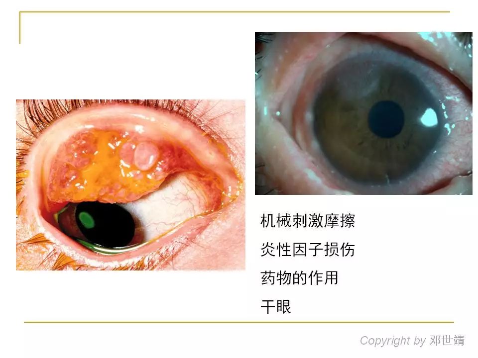 (按住图片可左右滑动)春季卡他性结膜炎合并的角膜溃疡被称为盾形