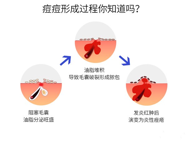 了解痘痘成因,科学"战痘"