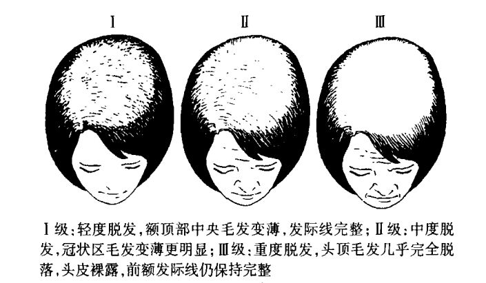 有这么多种脱发类型,你将是哪一种?