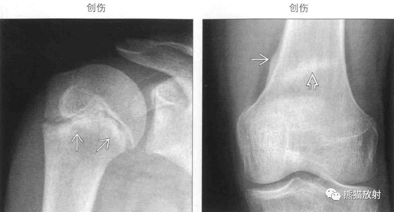 左图:小棒球运动员, 反复慢性损伤,肱骨近端生长板不规则,干骺端见