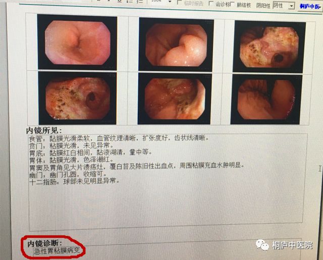 出血为主的胃黏膜急性炎症,部分可形成多发浅表溃疡,病变常局限于粘膜